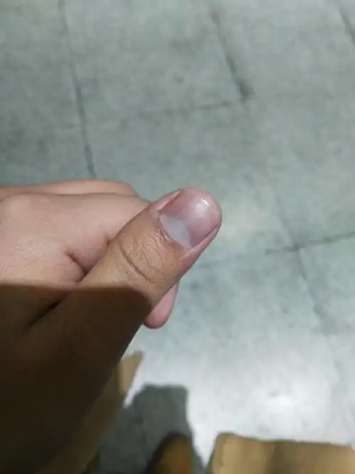 最近发现手指甲月牙上发紫