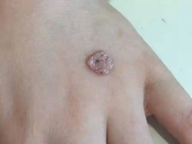 瘊子图片瘊子有传染性