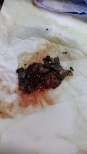 我的朋友在用百福丹治疗妇科炎症用完后下面排出一些类似于肉的东西