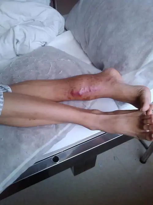 左腿的骨肉瘤高清图片 腿部巨大骨肉瘤高清图片