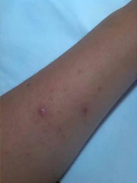 问:胳膊上长出了一个个小疙瘩,这是怎么回事,怎么治疗.专业的来.