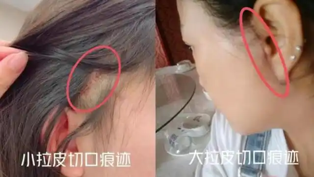 小拉皮的切口属于微创,切口小,短一点,选择