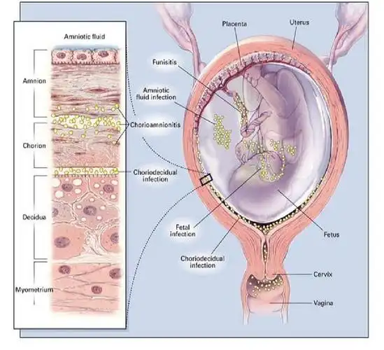 712:羊膜腔内感染的产时管理|新生儿|败血症|羊水|妊娠|胎盘|胎儿