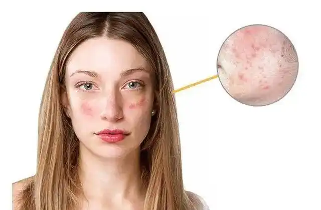 皮肤屏障受损?试试水光焕肤强韧肌肤!