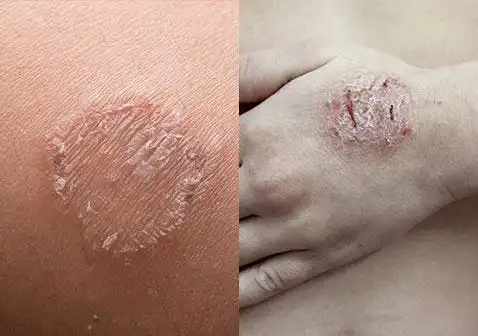 湿疹和癣的区别图片