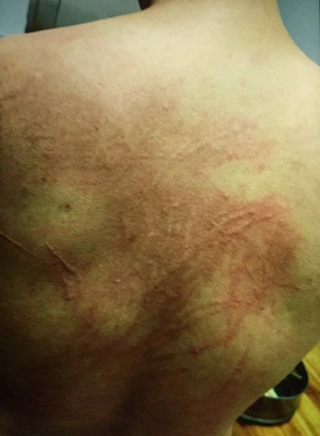 不管什么季节,背上都能抓出这样的疮来.