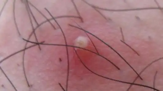 "阴毛囊炎"的图片搜索结果