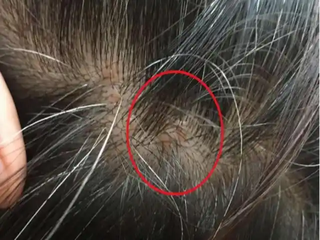 为什么头皮老是长疙瘩?或与这3种病有关