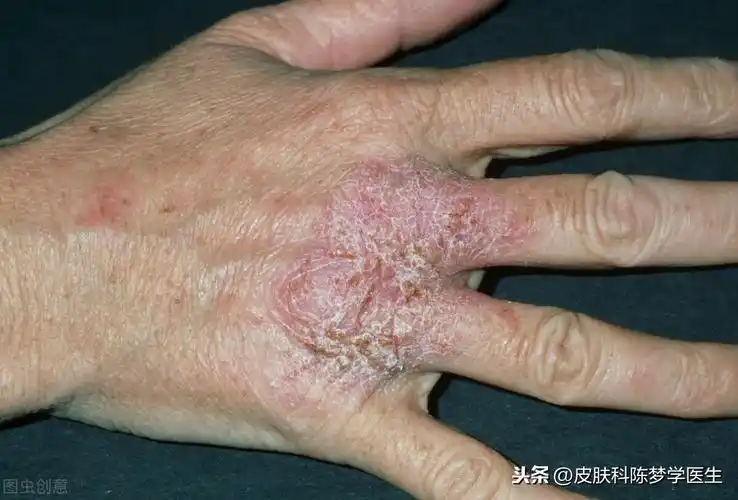 8种常见皮肤病对应的外涂药膏,用错了可能会加重病情