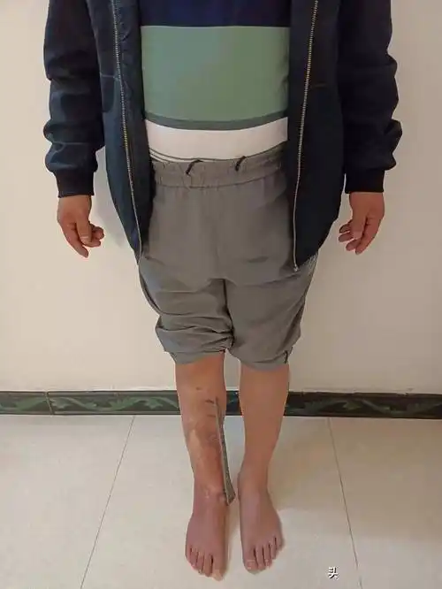 黄冈工人被机器砸裂右腿险截肢 武汉医生妙手保腿助他重新行走_黄先生