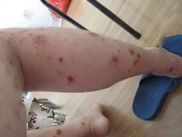 湿疹和皮癣的区别图片