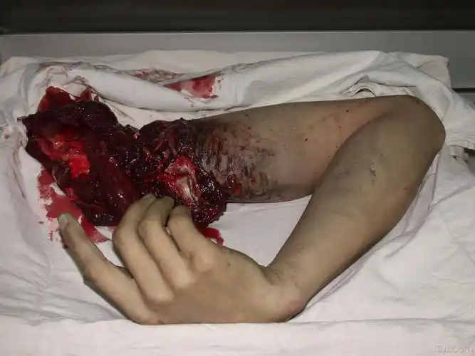 上肢离断伤一例报道