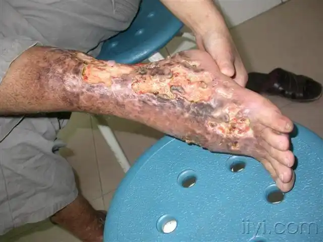 双下肢溃疡,疼痛两月(公布答案:坏疽性脓皮病) - 皮肤及性传播疾病讨