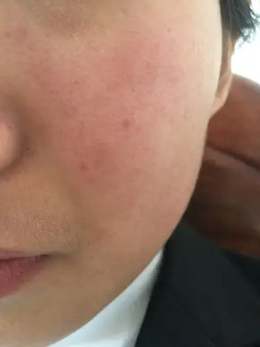 角质层薄这是属于什么皮肤