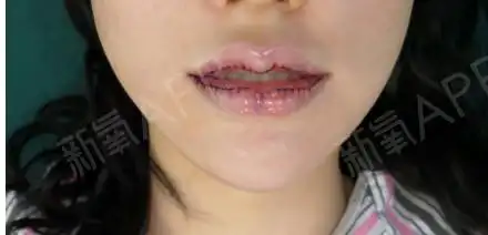 做这个m唇了,有想过打个玻尿酸的,好看的整形嘴唇图片做嘴巴整形图片