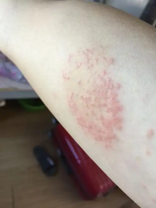 手臂内侧突然就起红疹很痒,红疹闱成圆形如图,擦了几天皮炎平没什么