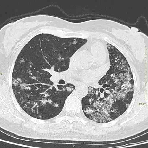 肺结核之烟花征——黄勇老师经典病例分享