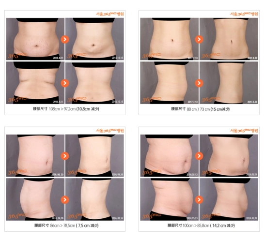 腹部吸脂 - 365mc专业吸脂医院