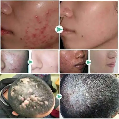 治头皮毛囊炎药膏头部背部脸部脓疮包痤疮痘痘疙瘩皮肤瘙痒止痒膏专用