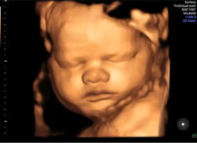 孕妈做四维彩超几经周折,却被宝宝丑哭,了解背后原因以免留遗憾