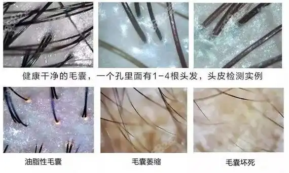 大麦植发头皮理疗对脱发有用吗做头皮理疗还有哪些作用