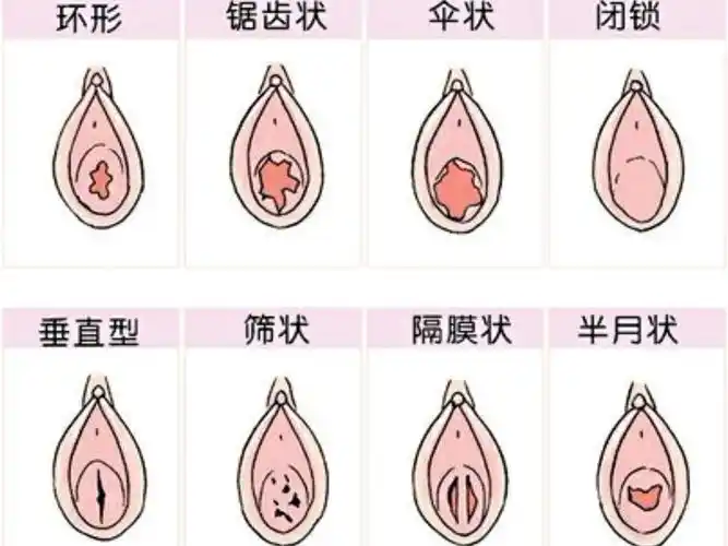 【处女膜修复】目前来说,到医院做手术的可能有这几种.