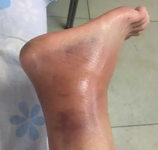 意外伤害险崴脚