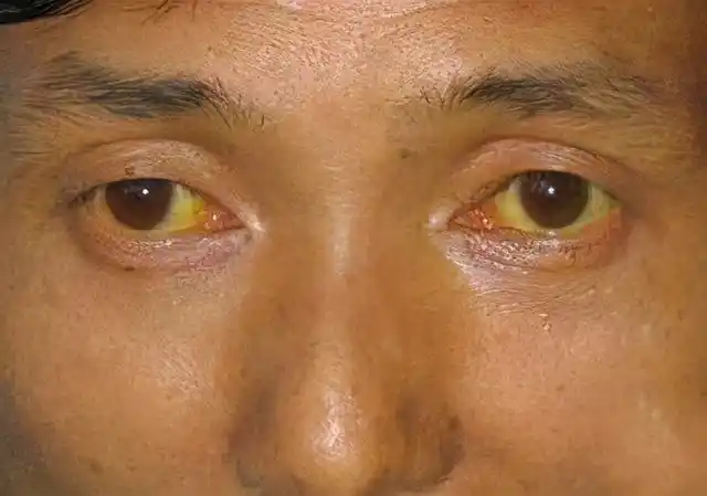 37岁男子眼黄入院,确诊肝癌,医生:身体早有提示,怪他不重视