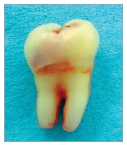 下颌第二磨牙萌出前冠内吸收一例