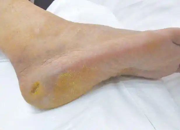 糖尿病周围神经病变引起脚变形引起糖尿病足