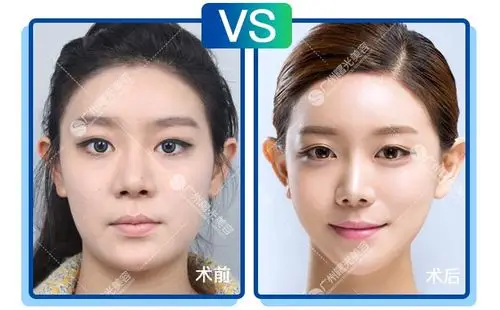 教师自体脂肪填充苹果肌前后对比