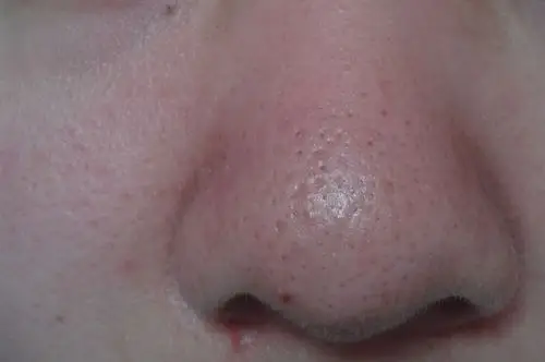 鼻子上毛孔大有黑头 什么方法比较有效呢