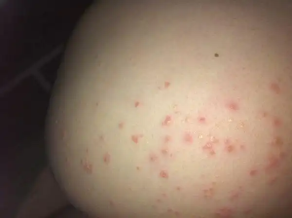 我的屁股上长了好多痘痘,有点痒,谁能帮忙看看,不胜感激