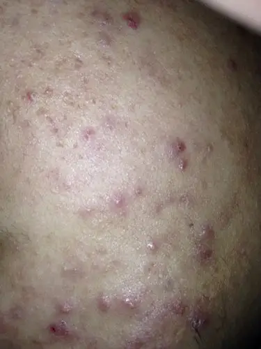 皮肤病 重度暗疮 0回答 碧尚化妆品去暗疮管用吗 2回答 耳朵旁边长了