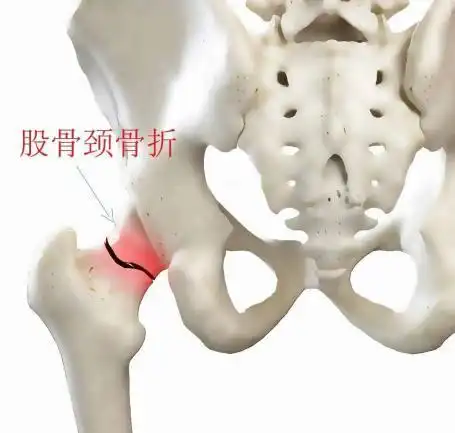 大腿根疼你怀疑过是这种疾病找上门吗