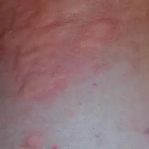 皮肤上的过敏反应,表现为肿胀和发红照片