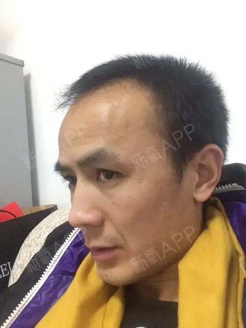 不知道现在这个年龄阶段为什么那么多发迹鬓角那里没有头发呢