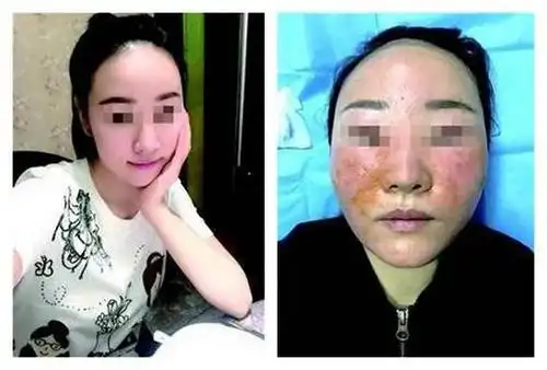 花3万美容变毁容盘点整容失败案例女星变女丑