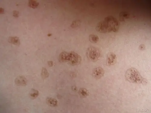 遗传性皮肤病请大家诊治 - 皮肤及性传播疾病讨论版 - 爱爱医医学论坛