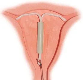 作为一种补救措施 避孕环并非人人都适用