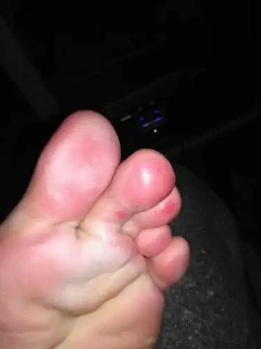 脚板底发红发肿,有点像烧伤一样痛,今天上午轻微痛