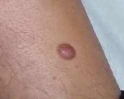 隆突性皮肤纤维肉瘤的知识 - 好大夫在线