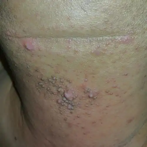 脖子上长了东西不痛也不痒有几年了