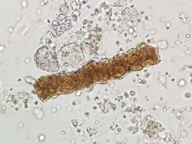 【多图对比】血液管型与血红蛋白管型鉴别|红细胞|镜检|沉渣_网易订阅
