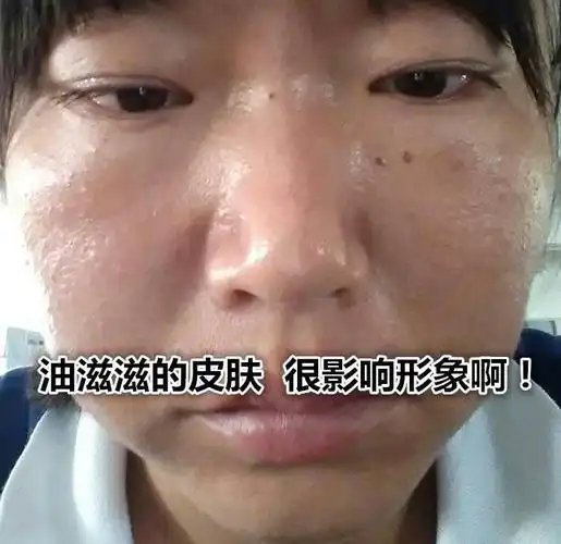 皮肤油性怎么改善皮肤油性大怎么解决