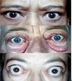 甲状腺相关性眼病(甲亢突眼)的诊治 - 好大夫在线