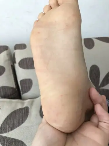 请问孩子脚上突然起了这些红点,感觉是皮肤内的,这是怎么回事?