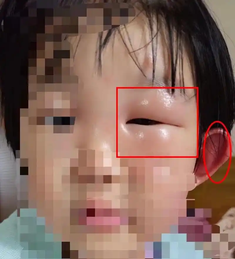 眼睛肿出大包 竟因小小蚊子!