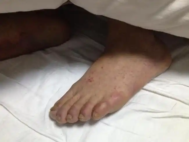 孩子螨虫过敏症状图片大全