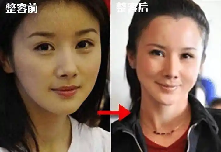 有些明星整容时好时坏,这是从"灵气十足"到"胶原十足"的过程_孙菲菲